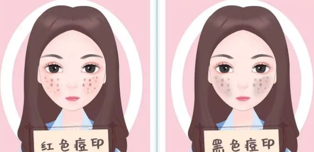 臉上紅色痘印幾個(gè)月都不消怎么辦？紅色痘印應(yīng)該怎么消除？